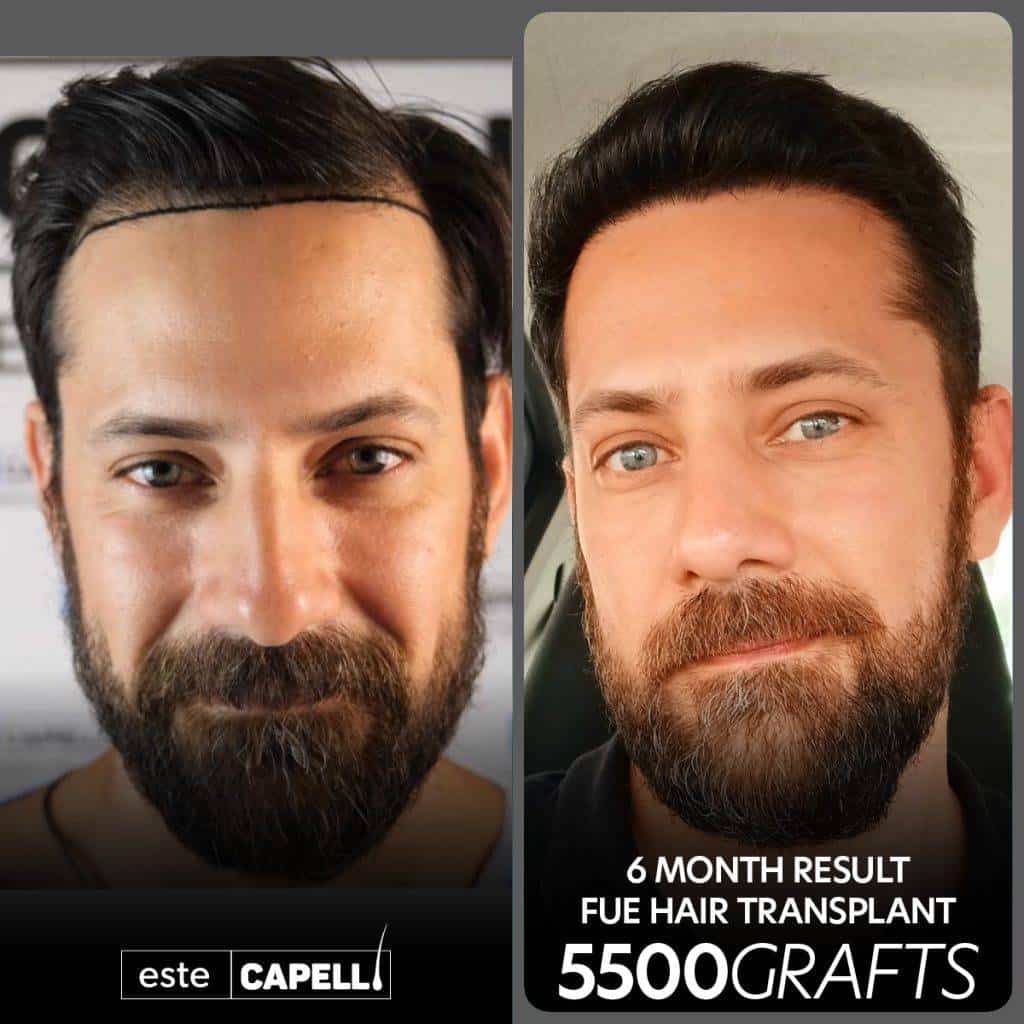 Greffe de cheveux FUE – résultat après 6 mois à la clinique EsteCapelli Istanbul Résultat avant et après greffe de cheveux FUE à la clinique EsteCapelli à Istanbul, 6 mois après la transplantation