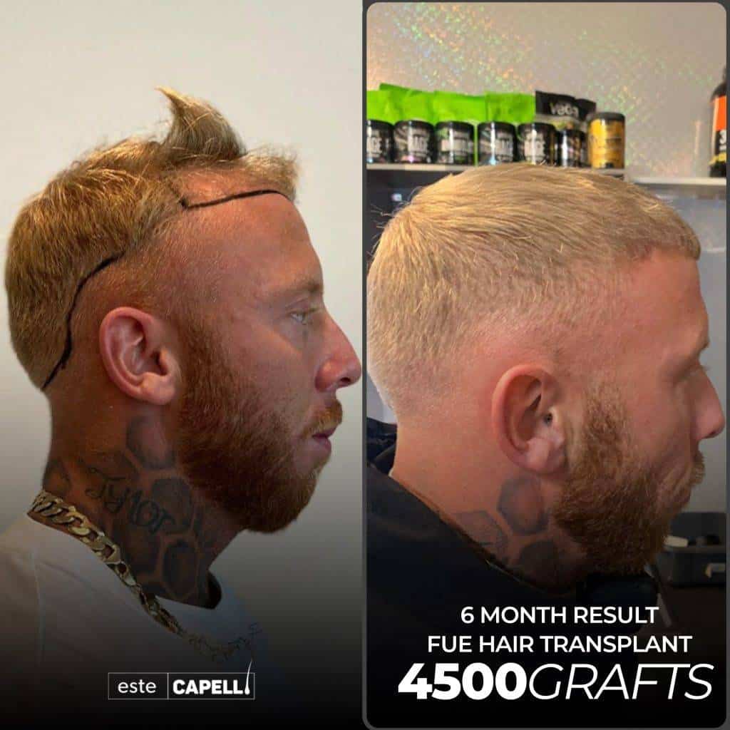 Greffe capillaire FUE de 4500 greffons – résultat à 6 mois à la clinique EsteCapelli Istanbul Perruque capillaire après greffe de cheveux, résultat visible 6 mois post-opération, 4500 greffons.