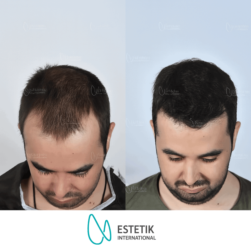 Avant et après une greffe de cheveux effectuée à la clinique Estetik International en Turquie