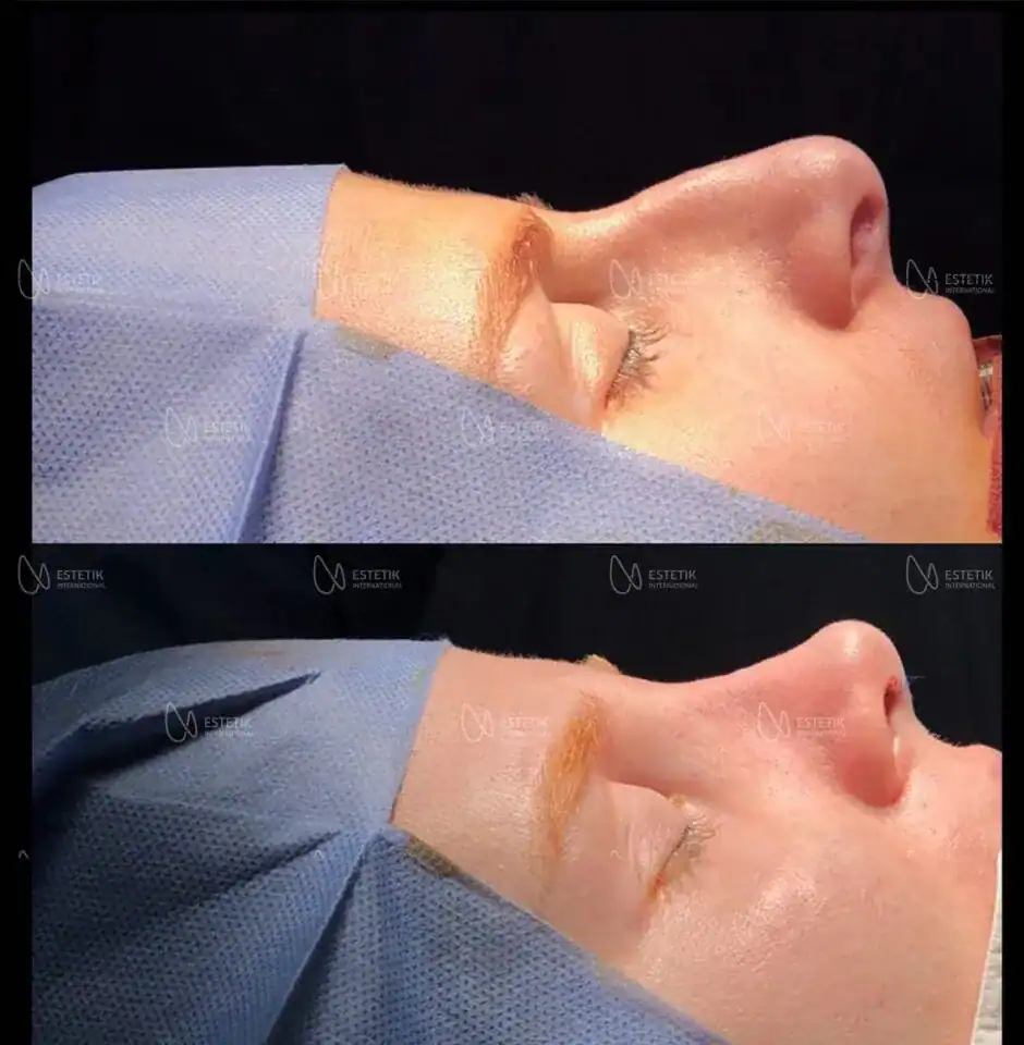 Avant et après une rhinoplastie réalisée à la clinique Estetik International en Turquie