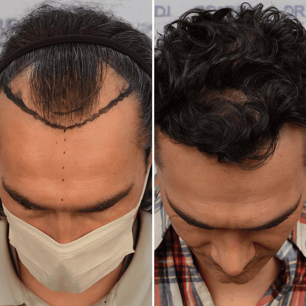Résultat avant et après greffe de cheveux chez un homme aux cheveux bouclés montrant une repousse dense et naturelle sur la zone frontale