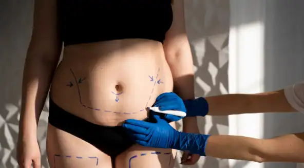 Lignes de chirurgie esthétique abdominale avant liposuccion ou lipofilling.