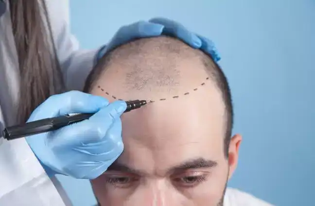 Chirurgie capillaire en Turquie pour la repousse des cheveux et la greffe capillaire spécialisée.