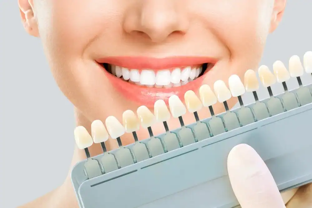 Dents blanches et naturelles pour sourire éclatant à la clinique BestClinic Turquie.