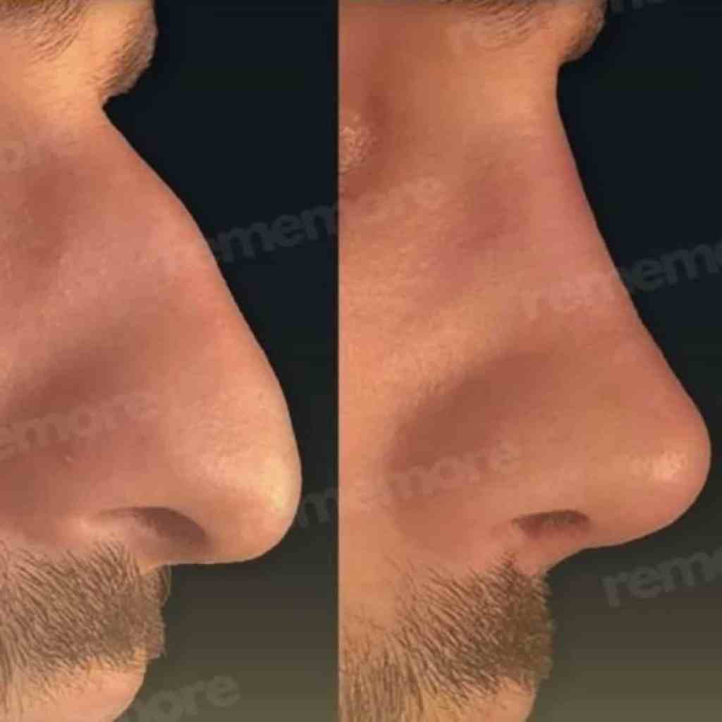N filename: resultat-nez-chirurgie-avant-apres-bestclinic-turkey.jpg.