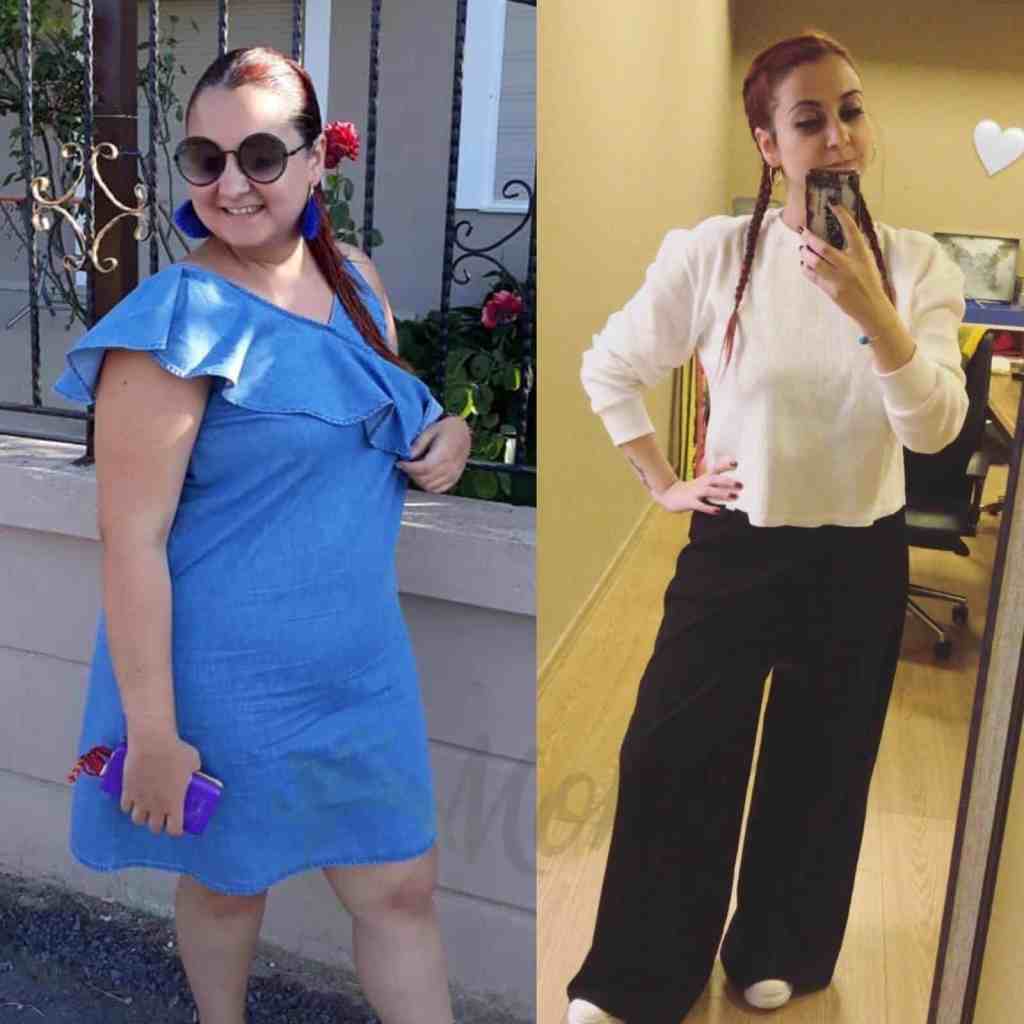 Trasformazione perdita di peso: confronto prima e dopo chirurgia bariatrica, sleeve gastrica e bypass con supporto nutrizionale