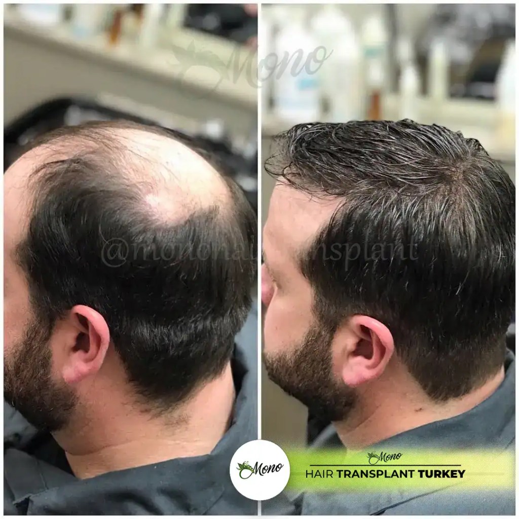 Risultato trapianto capelli prima e dopo presso Clinica Mono Izmir Turchia per calvizie maschile