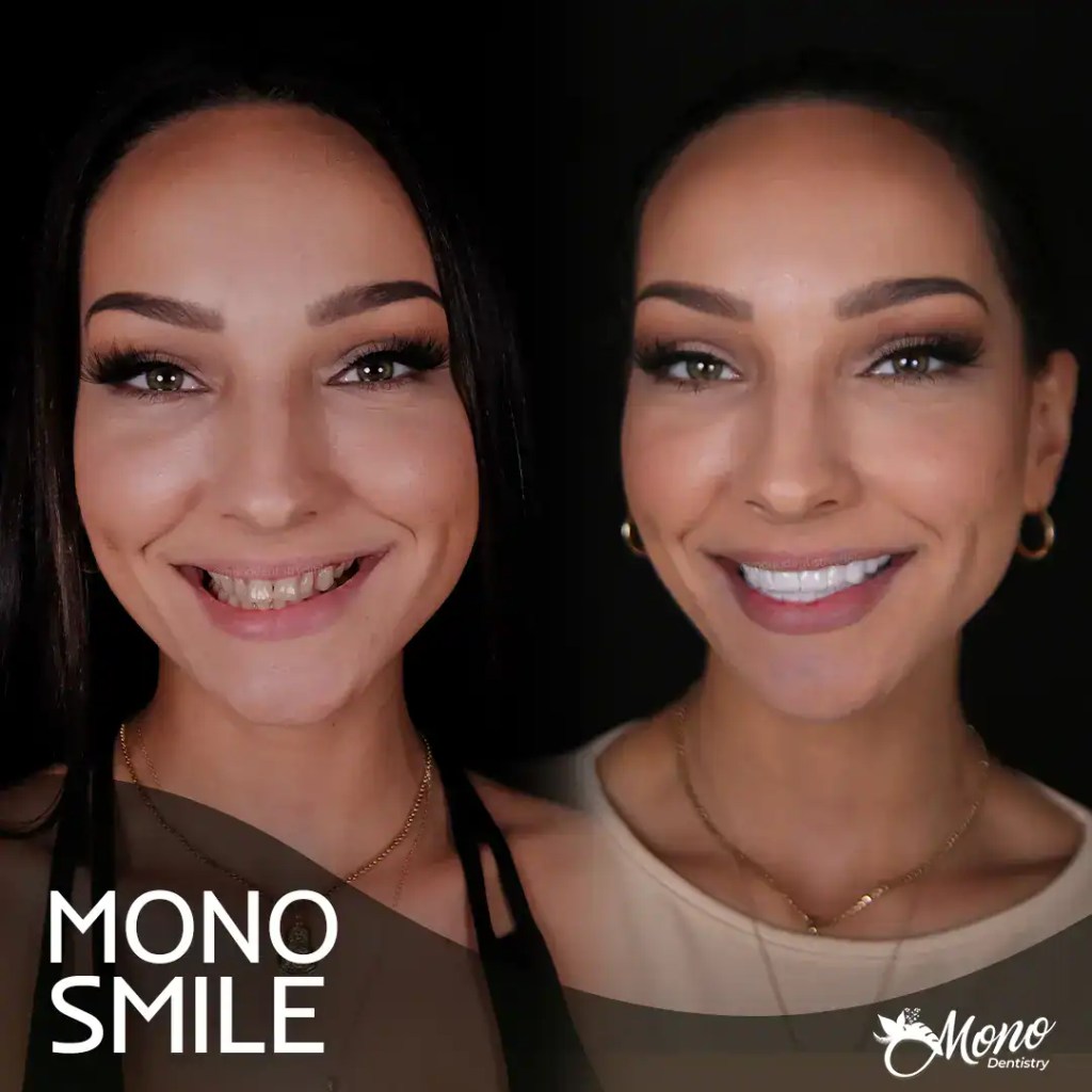 Risultato Mono Smile: giovane donna mostra sorriso perfetto dopo trattamento di corone in porcellana e odontoiatria estetica in Turchia