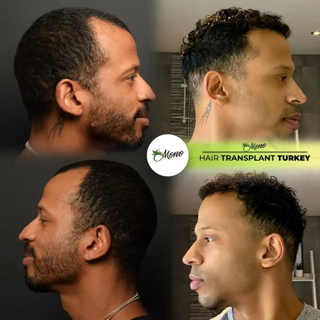 Evoluzione ricrescita capelli dopo trapianto follicolare su paziente maschile presso Clinica Mono Izmir
