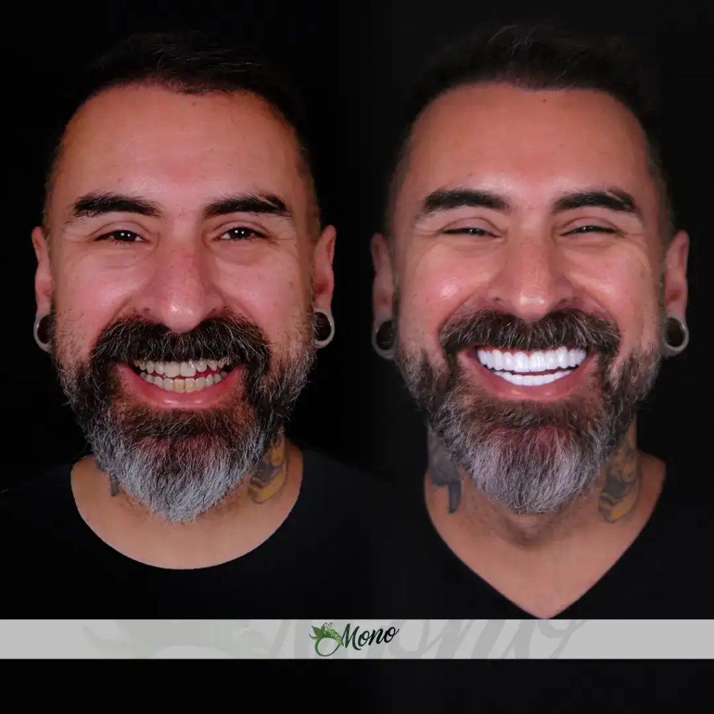 Trasformazione estetica dentale prima e dopo con faccette e corone presso Clinica Mono Izmir