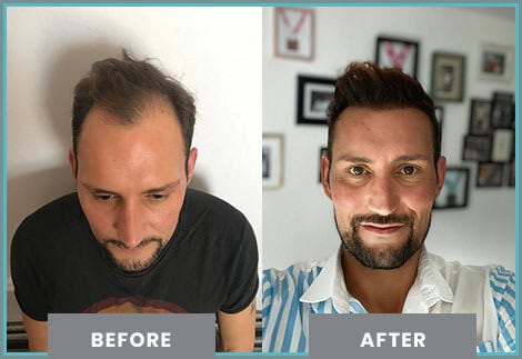 Risultato trapianto capelli prima e dopo: uomo con calvizie frontale e densità ripristinata presso clinica specializzata in Turchia