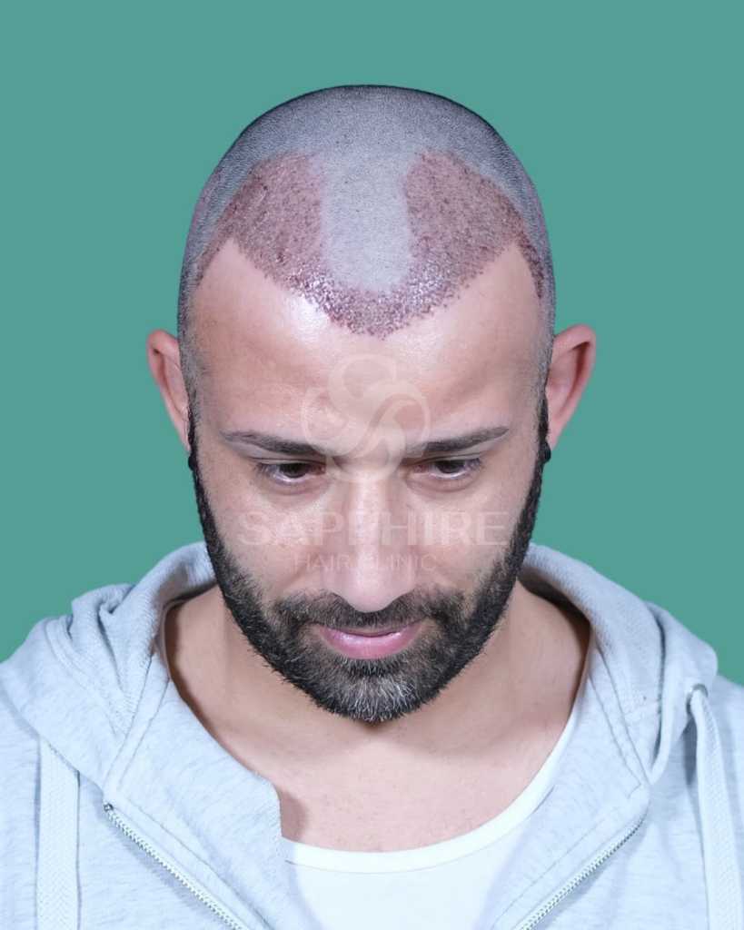 Paziente uomo con segni pre-operatori per trapianto di capelli alla Sapphire Hair Clinic