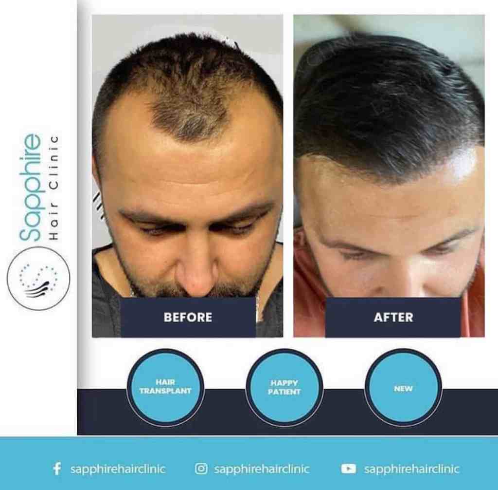 Testimonianza paziente Sapphire Hair Clinic Istanbul: confronto fotografico prima e dopo il trattamento di infoltimento capelli con successo