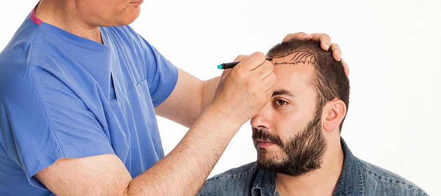 Chirurgo tricologo che disegna la linea sottile dei capelli prima di un trapianto DHI