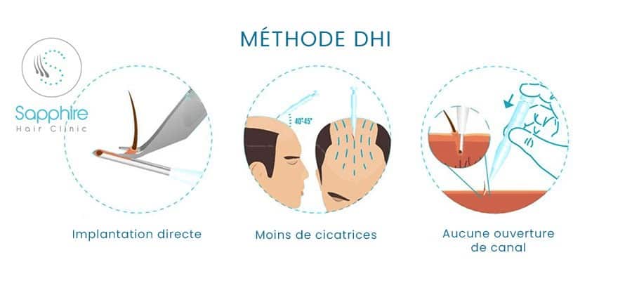 Schema tecnico metodo DHI Sapphire Hair Clinic: fasi di impianto diretto dei bulbi piliferi senza apertura del canale per meno cicatrici