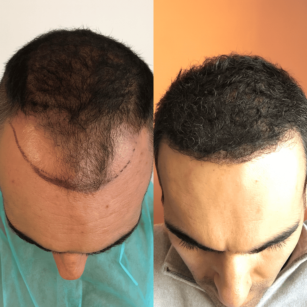 Confronto della ricrescita dei capelli dopo l'intervento: evoluzione della zona trattata
