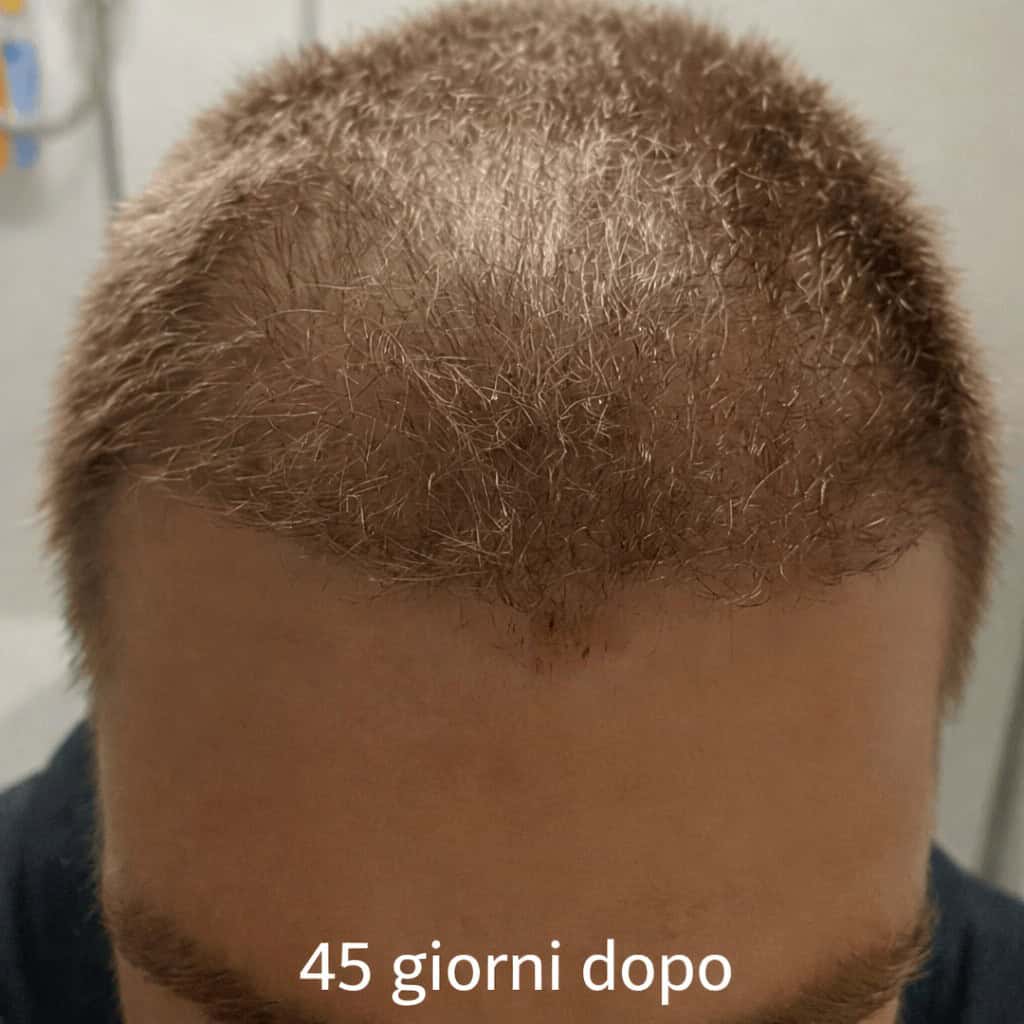 Risultato trapianto capelli a 45 giorni dall'intervento: ricrescita iniziale dei follicoli e guarigione del cuoio capelluto