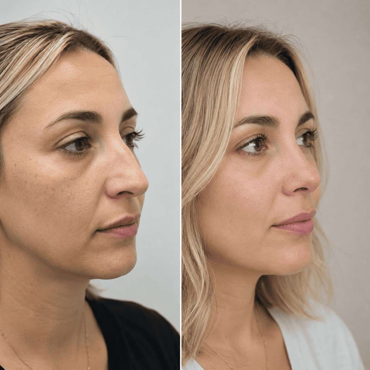 Prima e dopo una rinoplastica su una donna con un risultato naturale ottenuto in Turchia.