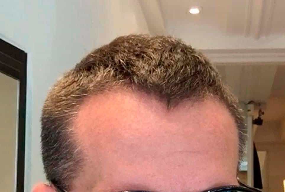 Efter hårtransplantation