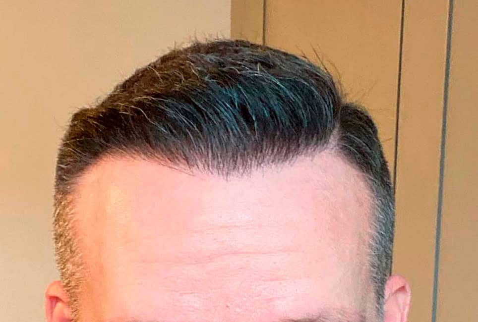Før hårtransplantation