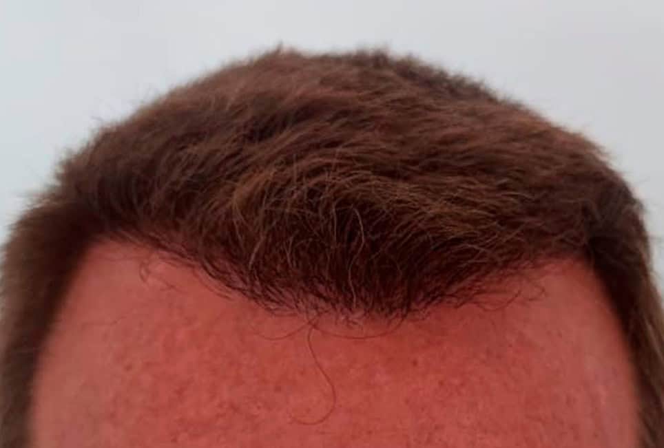 Efter hårtransplantation