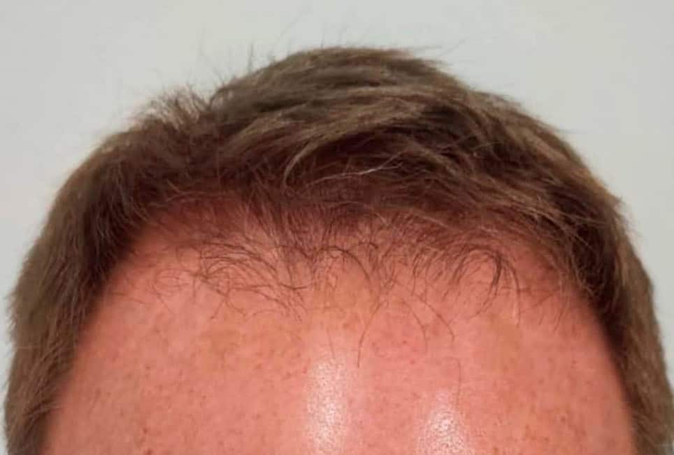Før hårtransplantation
