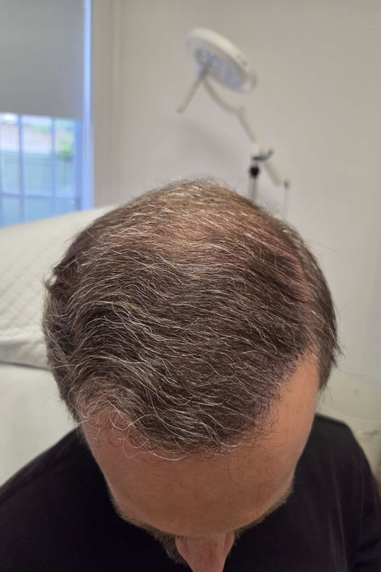 Efter hårtransplantation