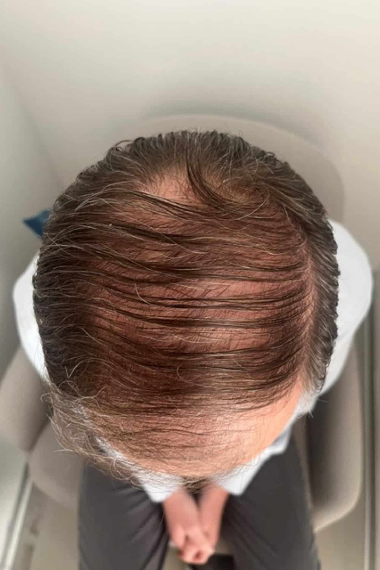 Før hårtransplantation
