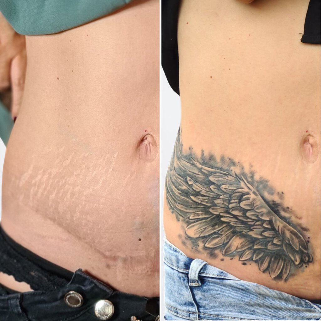 Narben-Cover Vorher-Nachher: Engelsflügel Tattoo über Kaiserschnittnarbe in Widnau.