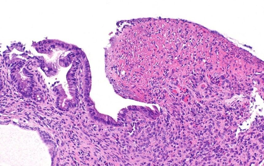 What Is The Fastest Way To Cure A Stomach Ulcer? 