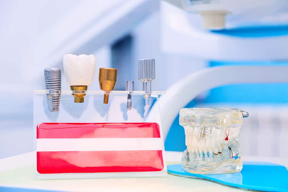 Cosa sono gli impianti dentali?