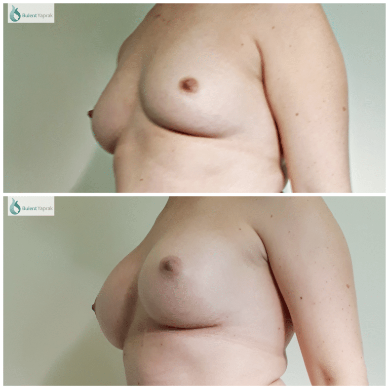 Breast Enlargement Before and After Photo by Bulent Yaprak   Plastic Sugeon Hamilton