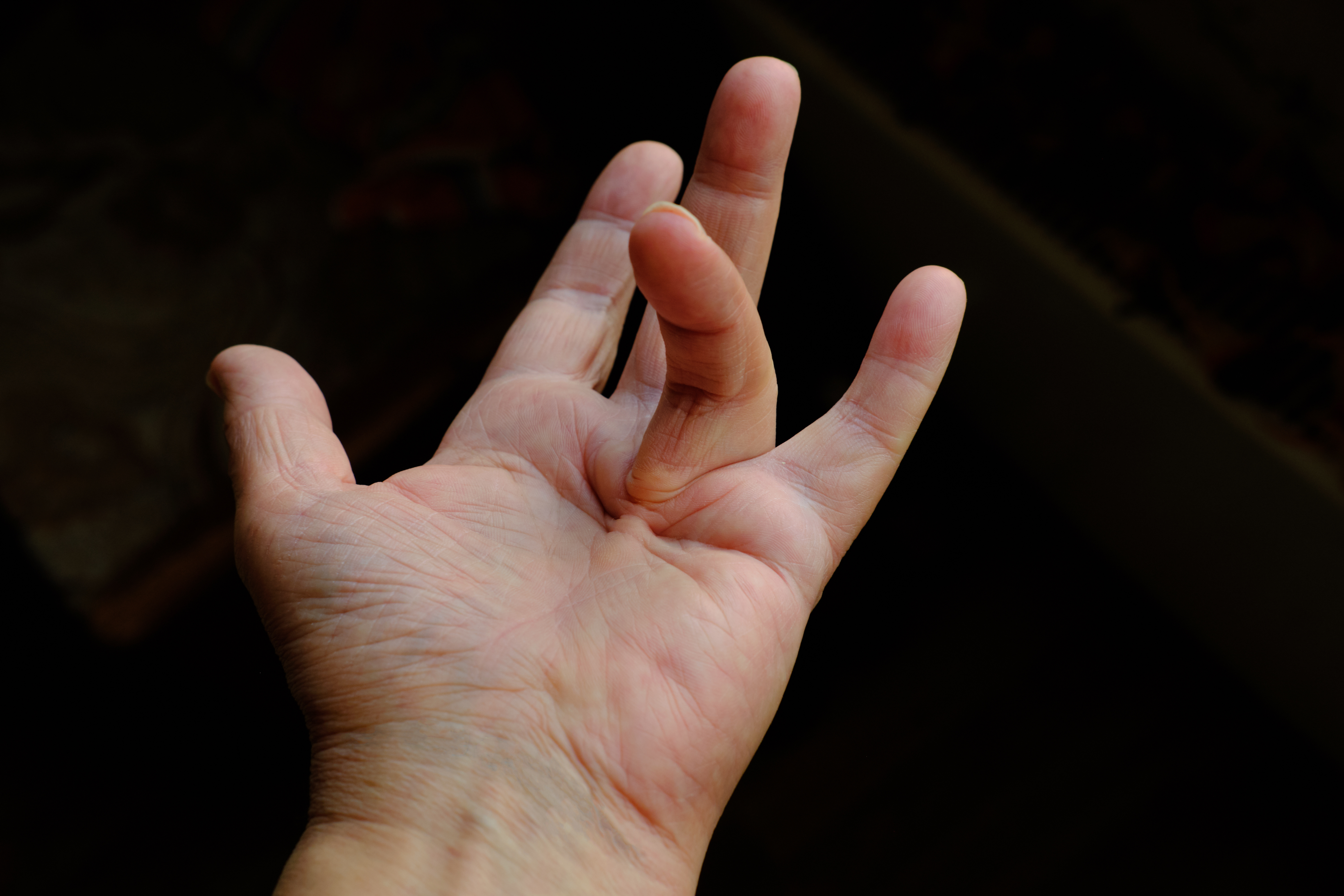 Dupuytrens contracture release   Bulent Yaprak