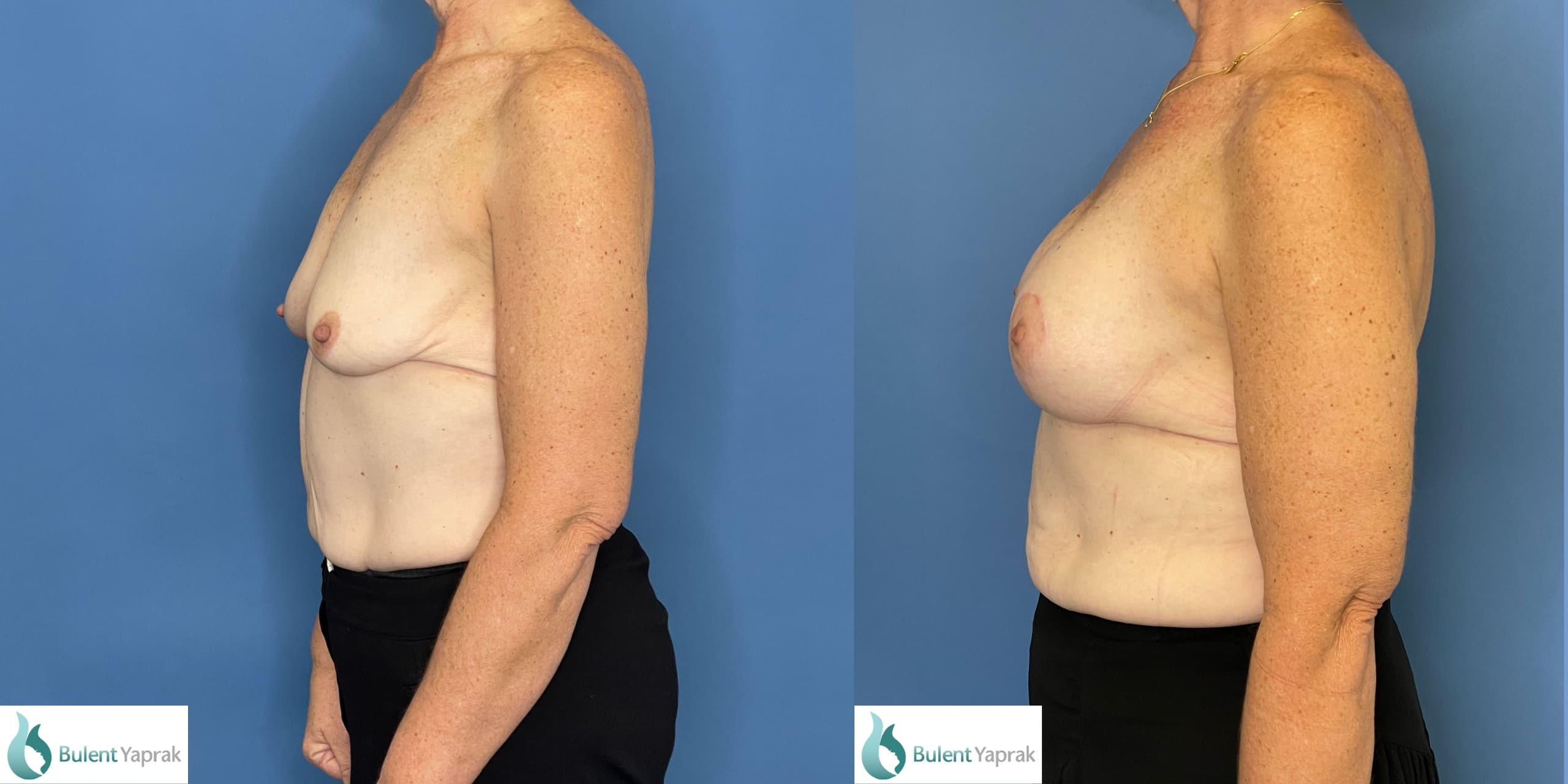 Side view of breast implants and mastopexy  breast lift Before and after photos