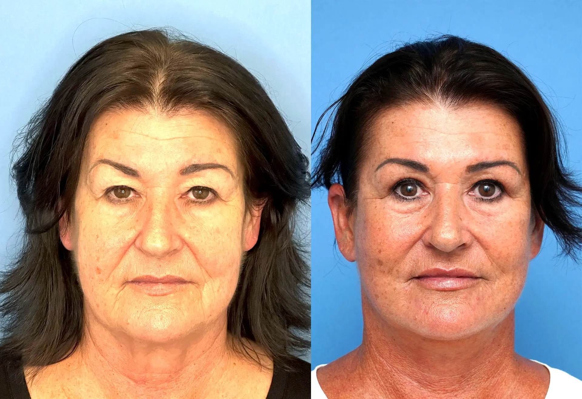 Facial surgery Hamilton NZ — facelift, blepharoplasty, browlift, neck lift by Dr Bulent Yaprak specialist plastic surgeon
