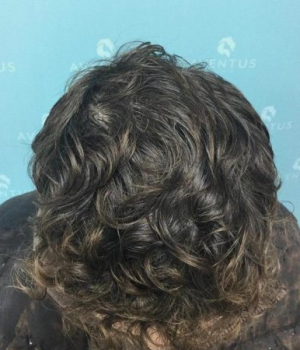 After-non-surgical-hair-treatment-2-e1762533956836-red4h5b1fjo63u0acgfzn47erb3qbhu2of6pkl7vl8