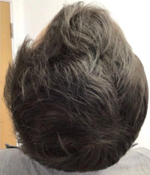 Non-Surgical-Hair-Treatment-After-4-red51o46nbrjlc74ibsr2xrpo5y8dlb3hzycs2sfqk