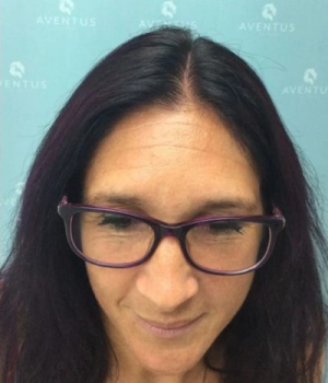 Non-Surgical-Hair-Treatment-After-6-red51kctvzmeawcl4a68sypvamgrisw65hceuyy0fg