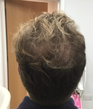 after-non-surgical-hair-treatment-1-e1762533936679-red4gmi9muyfnmrle8bg98y6vloe1jrfxu4zz1zr1o