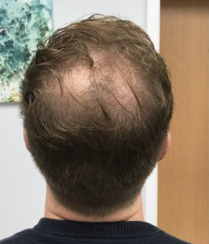 before-non-surgical-hair-treatment-1-red46odrazc6s77shfild9bkjspjkv9pkll04mqqwc