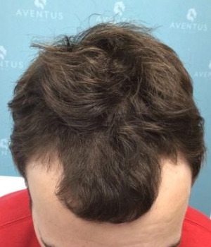 before-non-surgical-hair-treatment-2-e1764360149194-rfdwz41sa6oq9rak5qy2v8ls26rly8xjc8j7xkozak