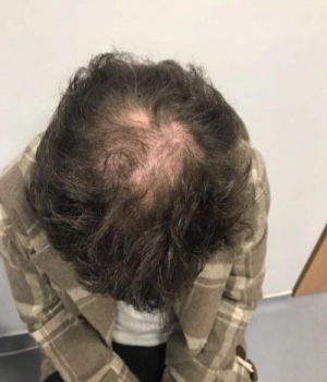 before-non-surgical-hair-treatment-3-red46jokct5r65em8vhgisi9kvcpidr1vybkq8xprg
