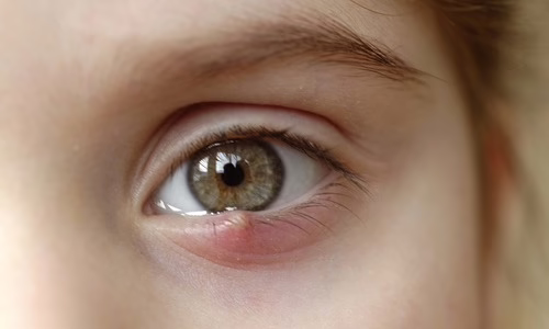 Close-up of a person's eye with a visible red stye on the lower eyelid.