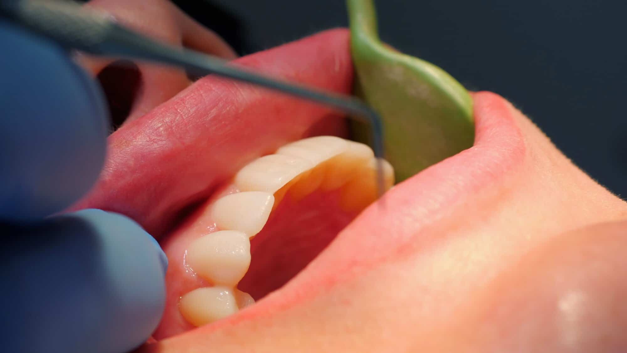 Close-up of a dental crown being fitted onto a patient's tooth during a dental procedure at Oroville Gentle Dentistry.