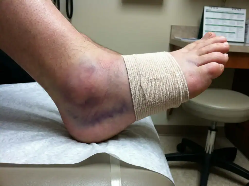 Foot injury with swelling and bruising after running exercise.