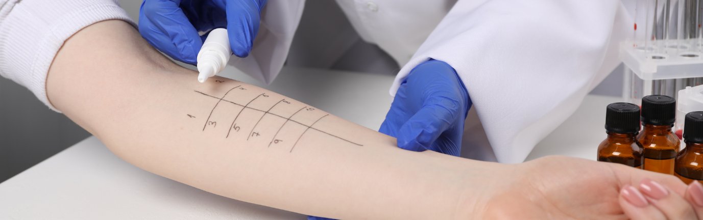 Test cutaneo per allergie con gocce di allergeni applicate sull’avambraccio e numerazione delle aree