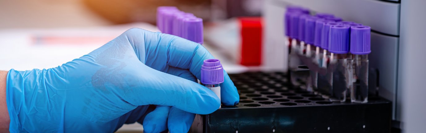 Tecnico di laboratorio posiziona una provetta in un supporto per analisi del sangue previste dalla visita ematologica