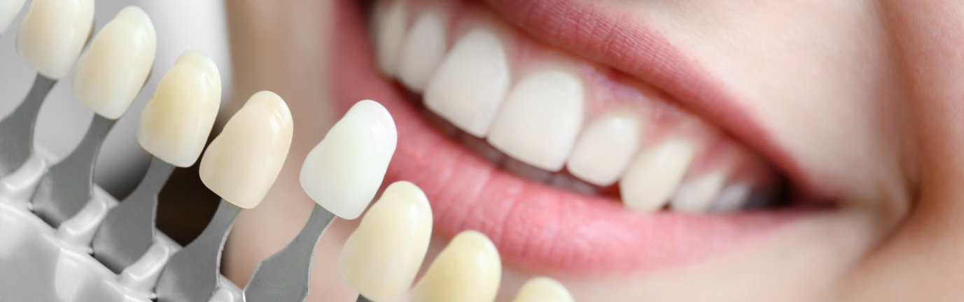 Sorriso con confronto tonalità dei denti per sbiancamento