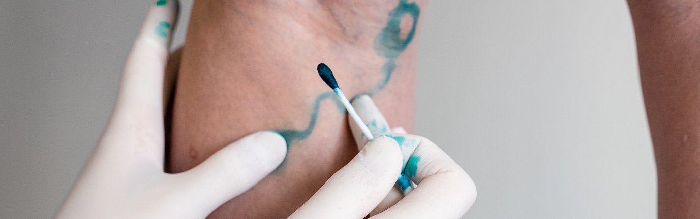 Trattamento di chirurgia vascolare con scleroterapia su vena varicosa