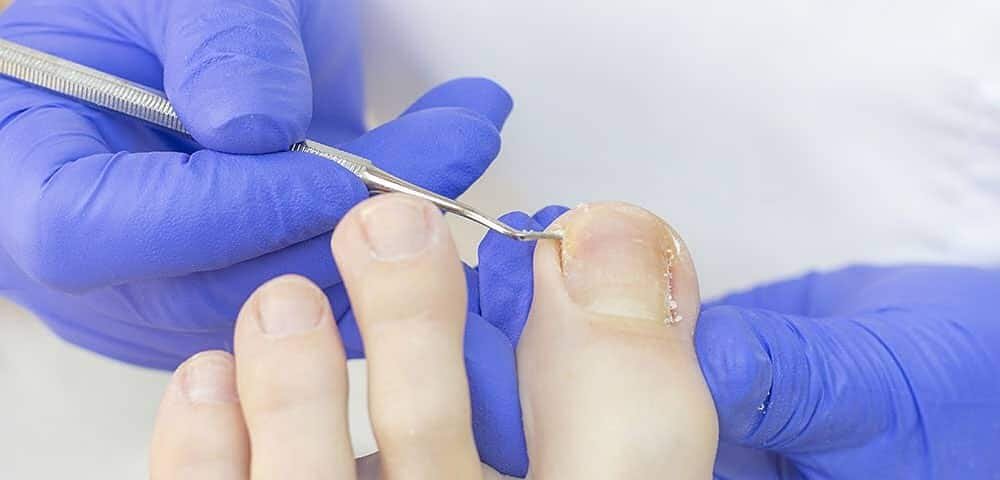 Cura unghia incarnita
